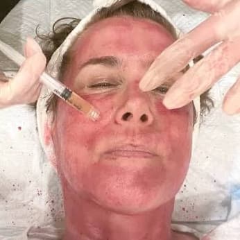 PRP Micro-needling Face&Neck Sale at All Aesthetics Kare in Upland, CA
