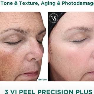 3 VI Peel Complimentary Glow Facial at All Aesthetics Kare in Upland, CA