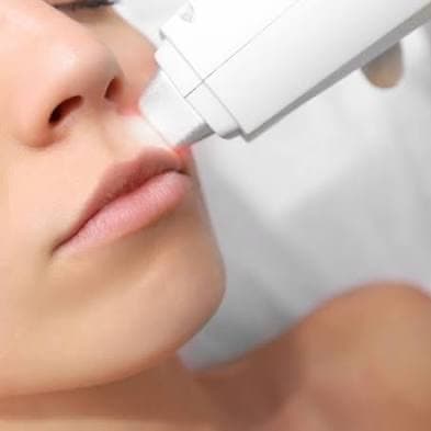 LHR Upper Lip 8 session package at All Aesthetics Kare in Upland, CA